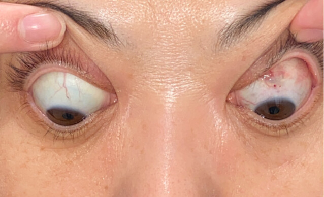 症例２の斜視の手術後の複視の改善　下向き