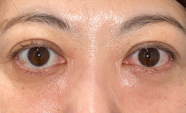 症例２の斜視の手術後の複視の改善　正面
