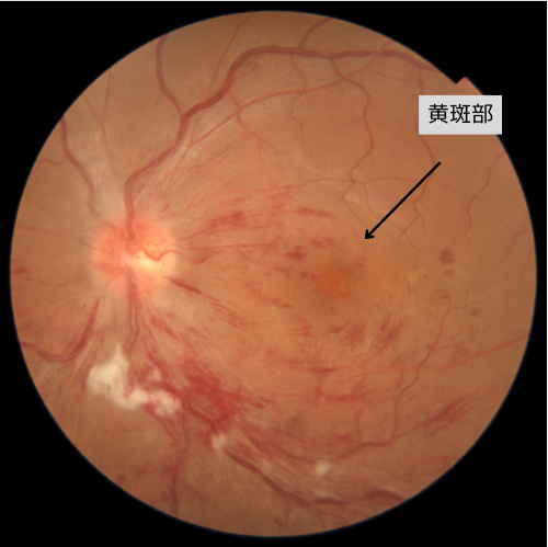 左眼網膜中心静脈閉塞症の治療前