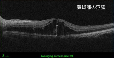 左眼黄斑部浮腫のOCT画像　
