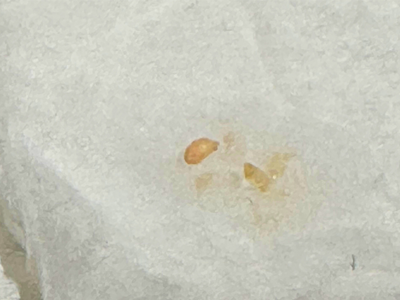 摘出したマイボーム腺梗塞