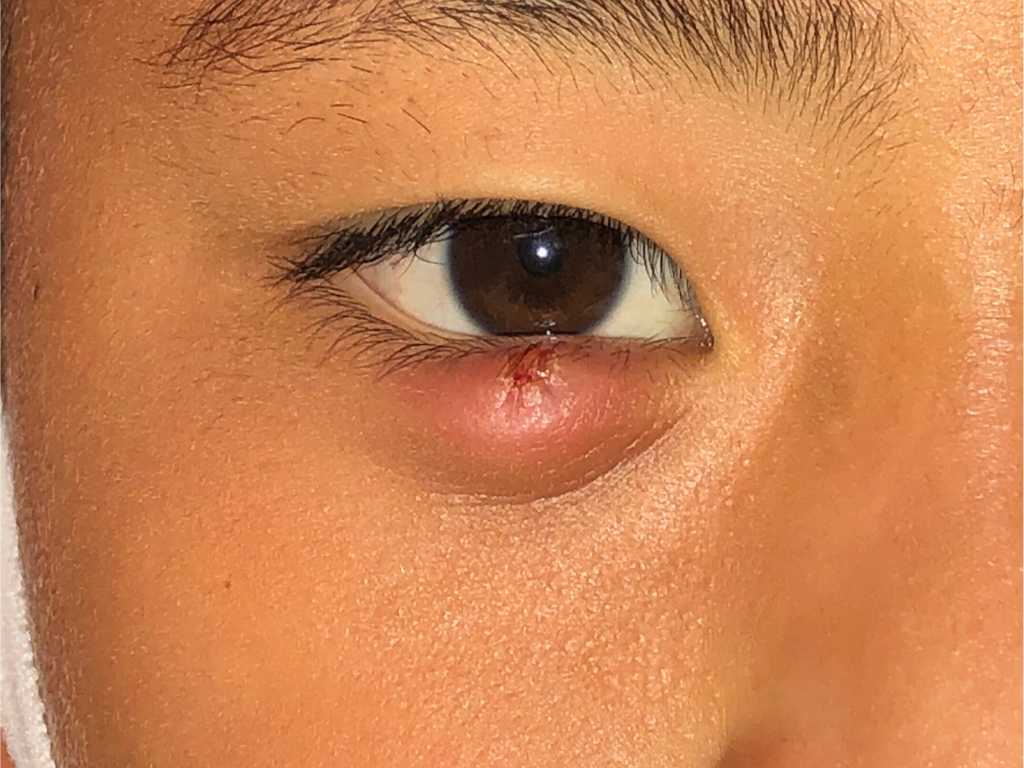 9歳男子霰粒腫の画像